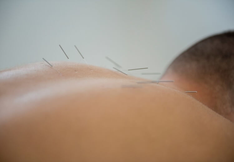 L’acupuncture : quel remboursement - Heyme